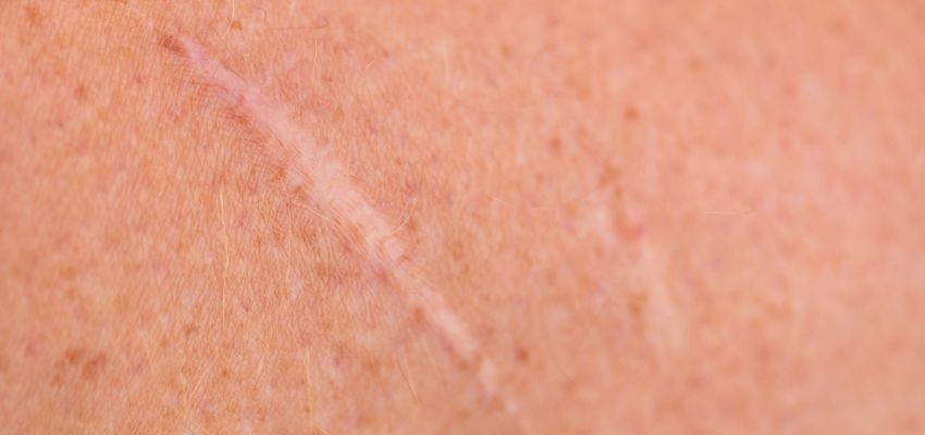 Keloids and hypertrophic scars are abnormal scar tissues that can form after an injury.